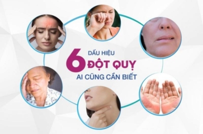 Dấu hiệu đột quỵ